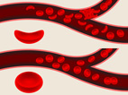 illustration of sickled red blood cells blocking a blood vessel, and normal cells flowing