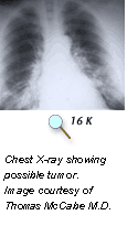 Chest X-ray showing pssible tumor.
