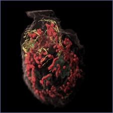 3D reconstruction of a melanoma cell