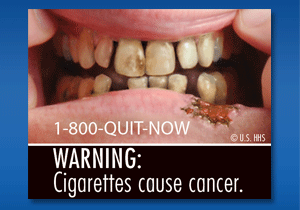 WARNING: Cigarettes cause cancer. Image: A mouth with stained and unhealthy teeth and a cancerous lesion on the lower lip.
Cessation Resource: 1-800-QUIT-NOW
Copyright: U.S. HHS