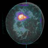 Novel Breast CT Scanner Enhances Ability to Discern Tumors/n