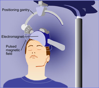 artist depiction of repetitive transcranial magnetic stimulation