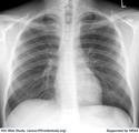 Chest Radiograph of AIDS Patient with Disseminated Histoplasmosis