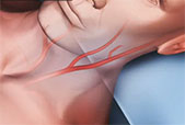 Image of carotid artery