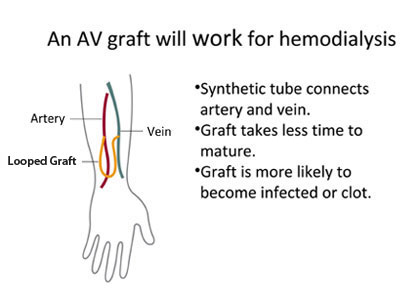 A graphic of a hand and forearm showing a looped, synthetic tube connecting the artery running to the hand and the vein running back from the hand. An AV graft will work for hemodialysis. The graft takes less time to mature, but is more likely to become infected or to develop a clot.