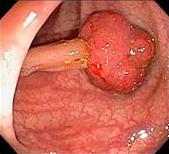 Colon polyp