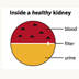 Graphic showing how albumin is filtered inside of a healthy kidney versus inside an unhealthy kidney