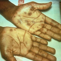 secondary rash from syphilis on palms of hands