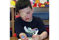 A child with amblyopia wearing an eye patch.