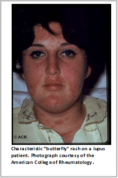 Characteristic 'butterfly' rash on a lupus patient.