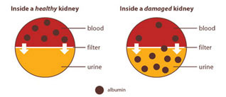 A diagram illustrating a healthy kidney with albumin only found in blood, and a damaged kidney that has albumin in both blood and urine