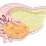 Ovarian cancer starts in fallopian tube