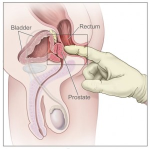 Drawing shows a side view of the male reproductive and urinary anatomy, including the prostate, rectum, and bladder; also shows a gloved and lubricated finger inserted into the rectum to feel the prostate.
