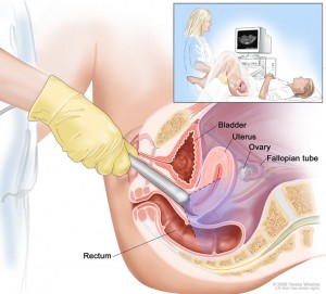 Drawing shows a side view of the female reproductive anatomy during a transvaginal ultrasound procedure. An ultrasound probe (a device that makes sound waves that bounce off tissues inside the body) is shown inserted into the vagina. The bladder, uterus, right fallopian tube, and right ovary are also shown. The inset shows the diagnostic sonographer (a person trained to perform ultrasound procedures) examining a woman on a table, and a computer screen shows an image of the patient's internal tissues.