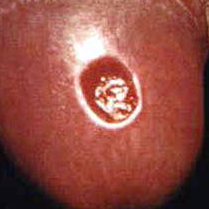 Ejemplo de una úlcera de sífilis primaria
