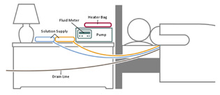 A schematic of a continuous cycler-assisted peritoneal dialysis exchange while person is sleeping