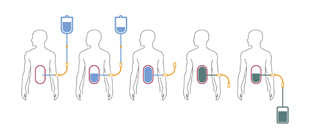 A schematic showing during a cycle of peritoneal dialysis or exchange