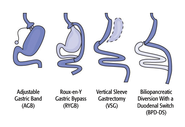 Diagram of Surgical Options. Image credit: Walter Pories, M.D. FACS.