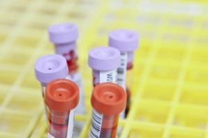 Six blood samples with purple or orange caps, sitting in a yellow tray