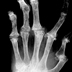x-ray image of a human hand with several bent fingers.