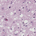 Image of human brain tissue with Creutzfeldt-Jakob disease.