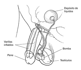 Ilustración de un implante peneano para tratar la disfunción eréctil. Una erección se produce al estrujar una peque~a bomba implantada en el escroto. La bomba causa que el líquido fluya desde el depósito de líquidos en la pelvis inferior hacia dos varillas inflables en el pene.