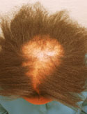 detailed image of central centrifugal alopecia