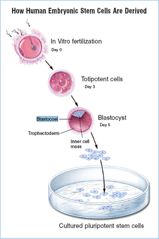 “How human embryonic stem cells are derived.“ In the upper left hand corner, the human egg is fertilized by a sperm in a test tube (in vitro); this is called day 0.  The next drawing shows day 3, when the embryo consists of large round cells, labeled as “totipotent (link to term in glossary) cells.“  At day 5, the drawing shows a blastocyst (link to term in glossary), which consists of an outer layer called the trophectoderm , a large fluid-filled cavity called the blastocoel, and a small mass of cells at one pole called the “inner “cell mass.“  The inner cell mass is removed and is then shown being grown in a tissue culture dish, where the cells are labeled “cultured pluripotent stem cells.”