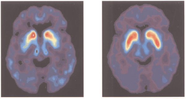 Positron Emission Tomography (PET) images from a Parkinson’s patient before and after fetal tissue transplantation. The panel on the left shows an image of an individual’s brain taken before surgery.   The red areas indicate uptake of a radioactive form of dopamine only in a region called the caudate nucleus, indicating that dopamine neurons in a region called the putamen have degenerated. Twelve months after surgery, an image from the same individual (right panel) indicates increased uptake of dopamine, especially in the putamen. (Figure reprinted with permission from N Eng J Med 2001;344(10) p. 710.)