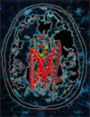 Structure of allergy-causing histamine receptor revealed