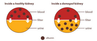 A diagram showing two circles that are half red (representing blood) and half yellow (representing urine). One circle illustrates a healthy kidney with dots representing albumin only found in the red half of the circle. The other circle illustrates a damaged kidney that has dots representing albumin in both halves of the circle.