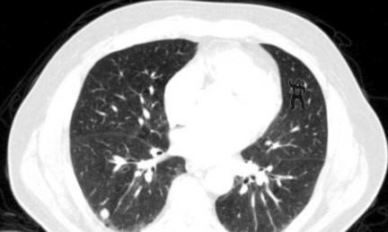 A hospital scan of a patient's lung with a small figure of a dancing gorilla at the top right