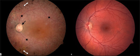Image of two retina