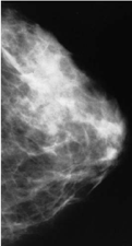 Ejemplo de una mamografía con resultados normales