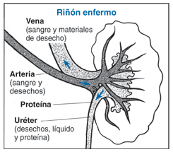 Ilustración del corte transversal de un riñón en que se delinea el uréter, vena, albúmina y arteria y se describe sus funciones dentro de un riñón enfermo.