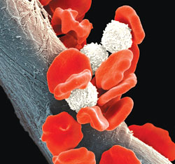 In leukemia, abnormal white blood cells proliferate and circulate.