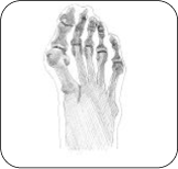 Graphic image of Bunions (Hallux Valgus)