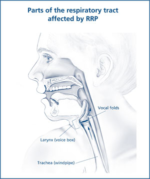 Illustration of the respiratory tract affected by RRP.