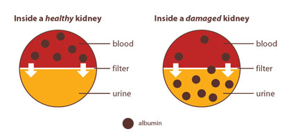 A diagram illustrating a healthy kidney with albumin only found in blood, and a damaged kidney that has albumin in both blood and urine.