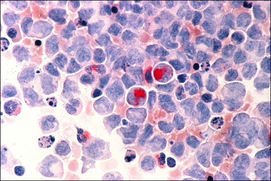 Acute myelogenous leukemia cells