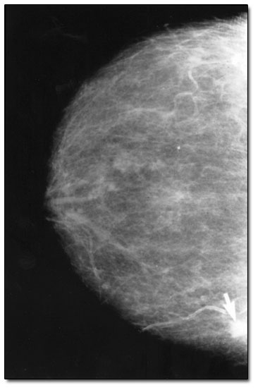 Mammogram of a breast with cancer ( a small, white lump about 3 millimeters in size) indicated by white arrow