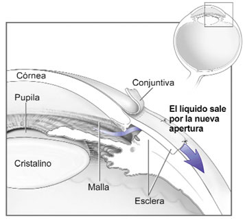 Imagen de un ojo después de la cirugía