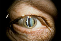 cataract lens