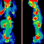  PET scans of  lymph nodes with lymphoma in the groin and armpit (red areas).  