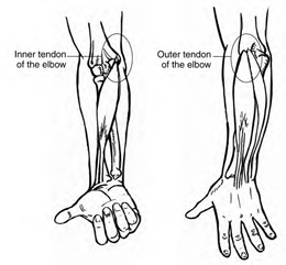 Illustration showing the inner tendon of the elbow with the palm of the hand facing the reader and an illustration showing the outer tendon of the elbow with the back of the hand facing the reader.