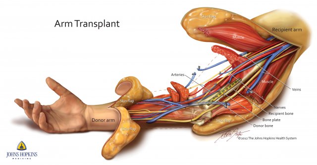 This illustration shows how muscle, blood vessels, nerves and skin had to be connected above Brendan Marrocco's elbow during a double-arm transplant for the infantryman at Johns Hopkins hospital, Dec. 18, 2012.