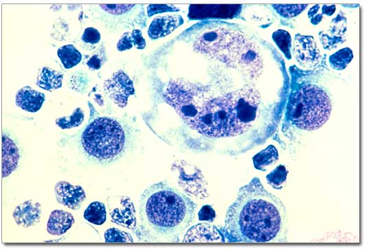 Human lymphoma tumor cells in the pleural fluid stained with a Defquick stain and magnified to 400x.
