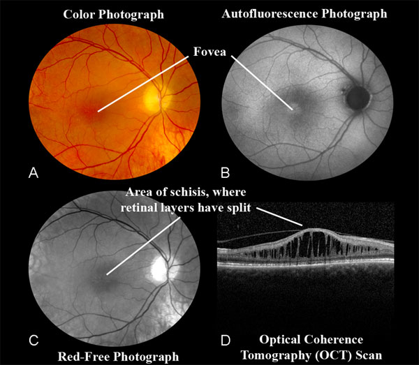 X-Linked Retinoschisis (XLRS)