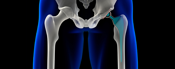 FDA Safety Communication: Metal-on-Metal Hip Implants