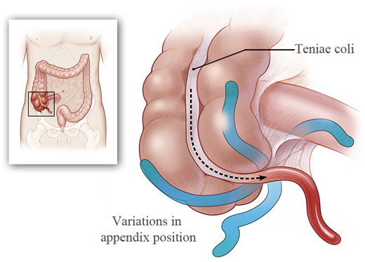 Diagram showing the appendix in various positions.
